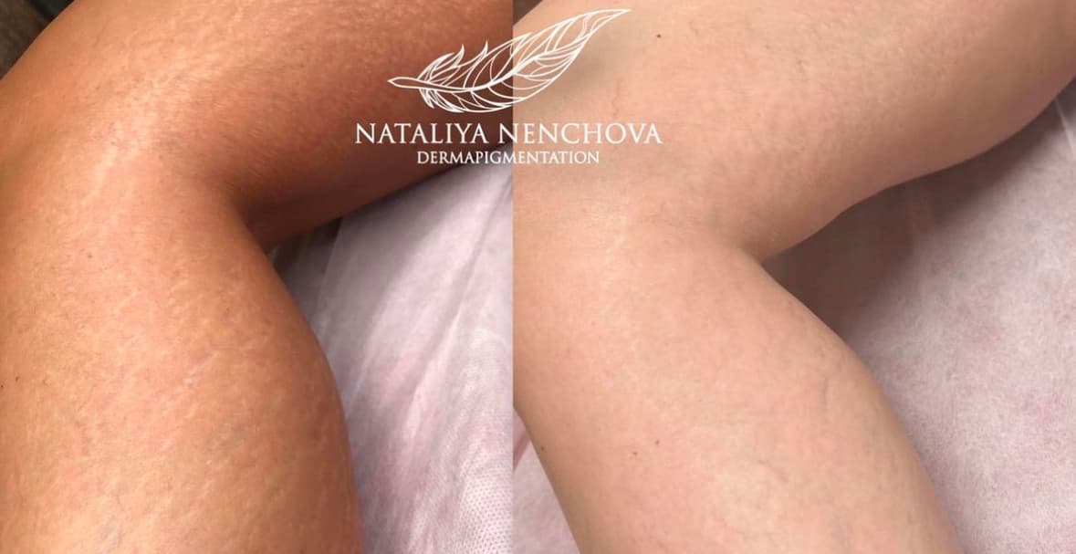 Наталия Ненчова — процедура